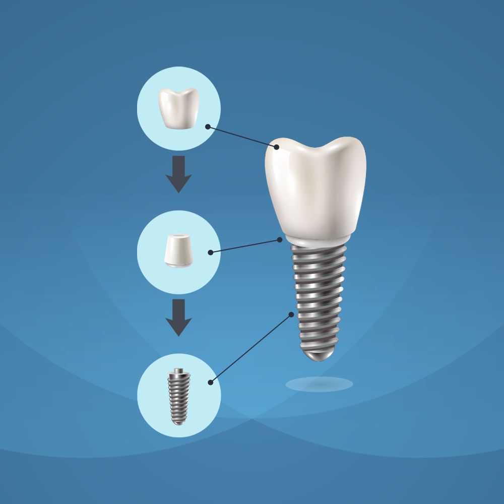 dental implants in dubai